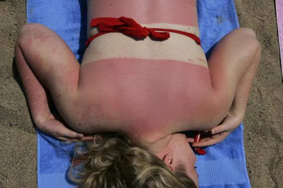 Skin Patch Tells You When You’ve Had Too Much Sun