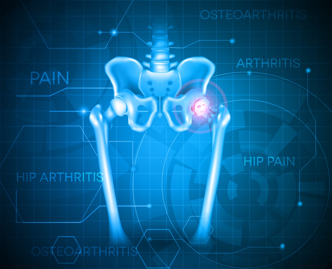 Biomaterials for Hip Replacement Prostheses