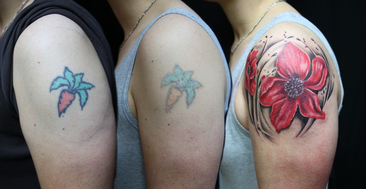 Analytical Chemistry And The Hidden Risks Of Laser Tattoo Removal
