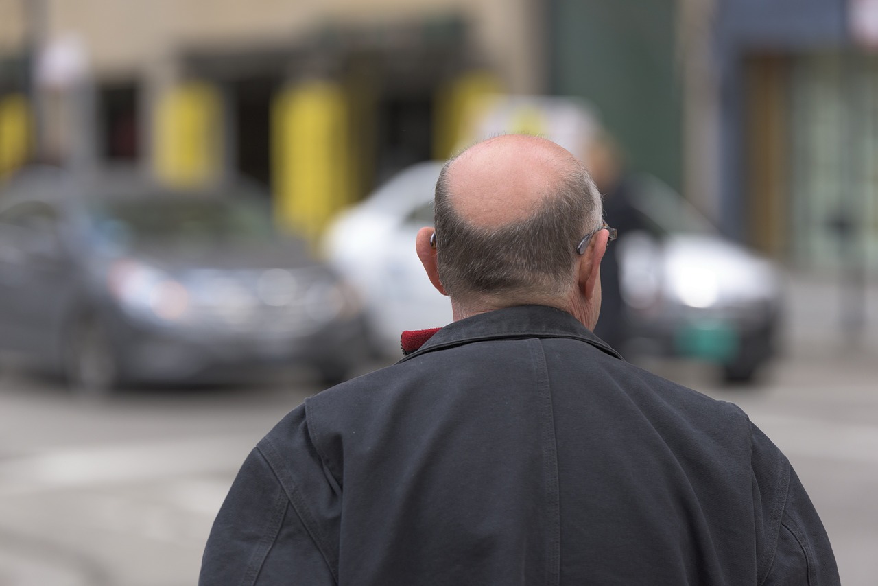 Using Stem Cells in Re-Seeding Hairlines