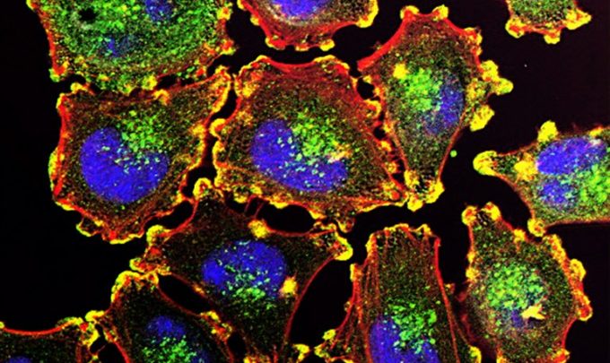 Benign Tumors