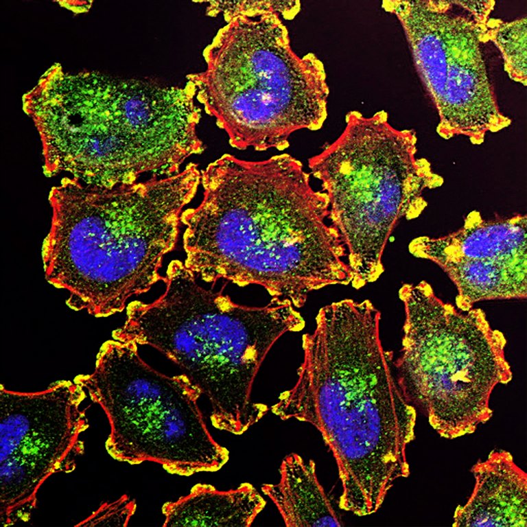 Benign Tumors