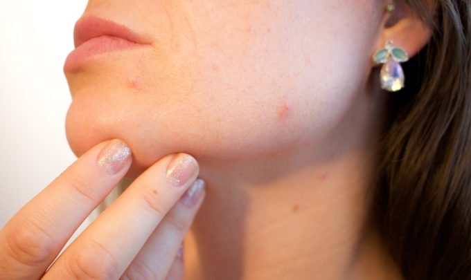 Novel acne treatments clear skin with fewer side effects