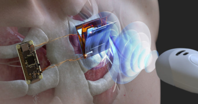 A wireless future for implantable medical device charging