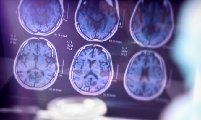 Uncovering key trends in Alzheimer’s disease: Insights from global experts